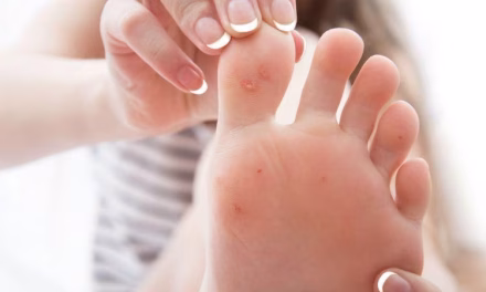 Kondisi Kulit Kaki Mengalami Mata Ikan Karena Beberapa Hal