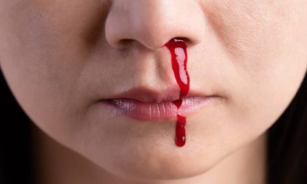 Kondisi Seseorang Mimisan Atau Pendarahan Pada Hidung