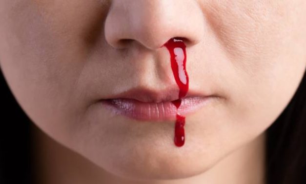 Kondisi Seseorang Mimisan Atau Pendarahan Pada Hidung