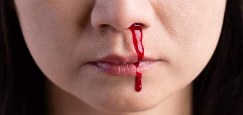Kondisi Seseorang Mimisan Atau Pendarahan Pada Hidung