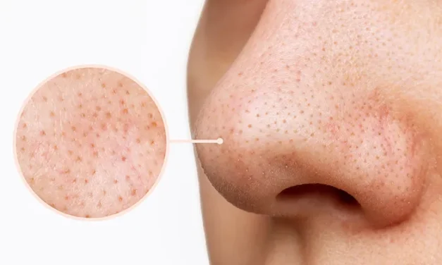 Permasalahan Kulit Salah Satu Paling Utama Komedo