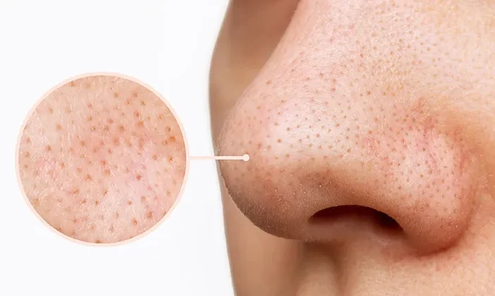 Permasalahan Kulit Salah Satu Paling Utama Komedo