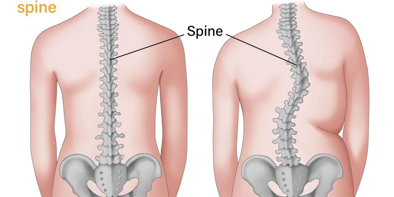 Kondisi Kelainan Pada Tulang Atau Skoliosis