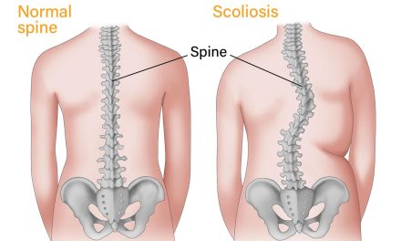 Kondisi Kelainan Pada Tulang Atau Skoliosis