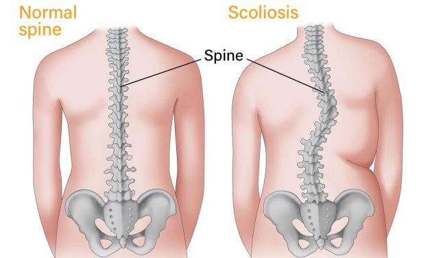 Kondisi Kelainan Pada Tulang Atau Skoliosis